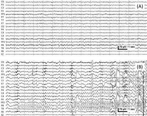 normal vs seizure eeg.